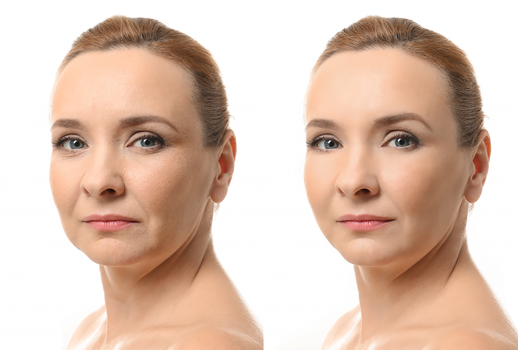 Skin Remodeling | San Anselmo Skin Tightening