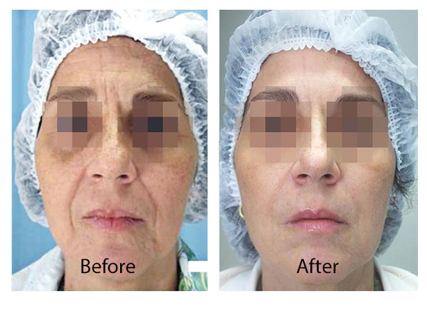 Before & After Skin Remodeling | San Anselmo Skin Tightening