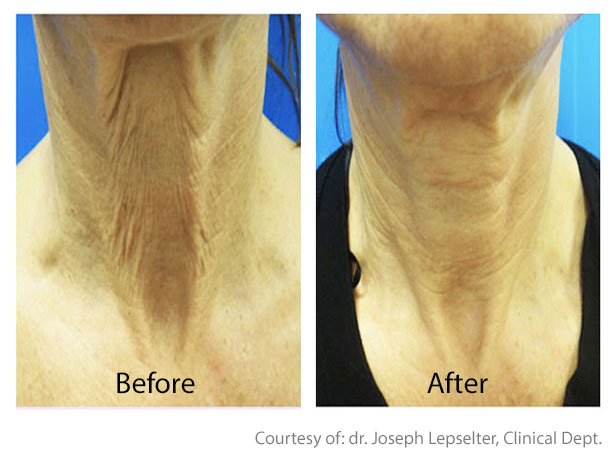 Before & After Skin Remodeling | Skin Tightening San Anselmo