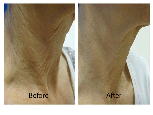 Before & After Skin Remodeling | Skin Tightening San Anselmo