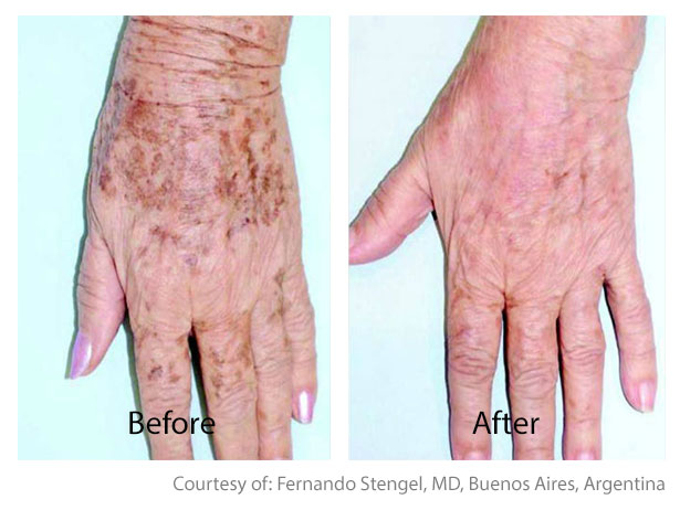 Before & After Skin Brightening | San Anselmo Pigment Correction