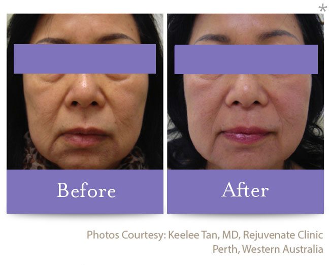 Before & After Skin Remodeling | Skin Tightening San Anselmo