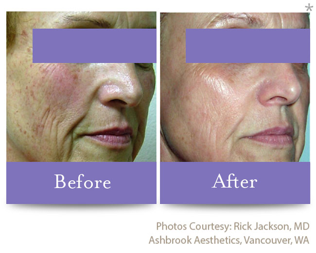 Before & After Skin Brightening | Pigment Correction San Anselmo
