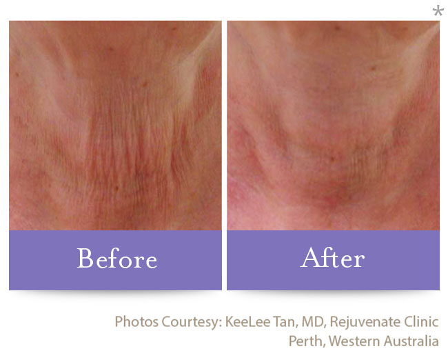 Before & After Skin Remodeling | Skin Tightening San Anselmo