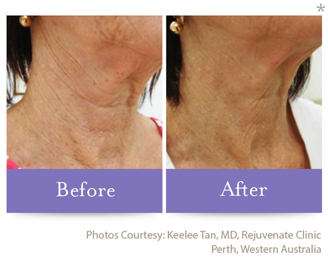 Before & After Skin Remodeling | San Anselmo Skin Tightening