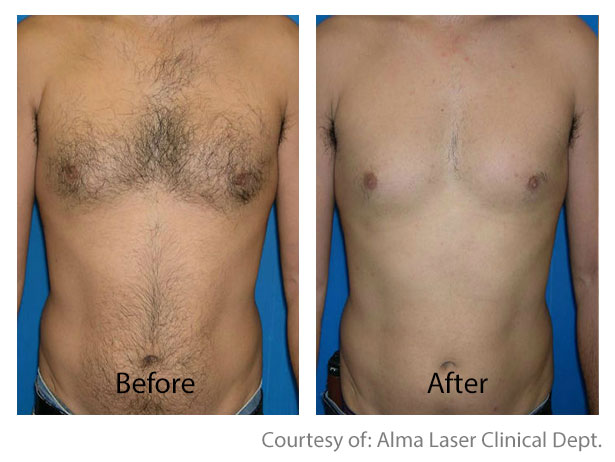 Before & After Hair Removal | Hair Removal San Anselmo