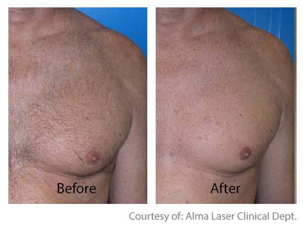 Before & After Hair Removal | San Anselmo Hair Removal