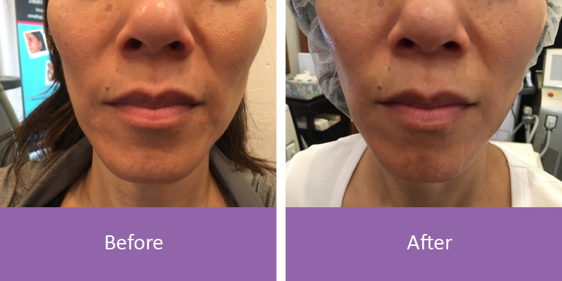 before-after before-after