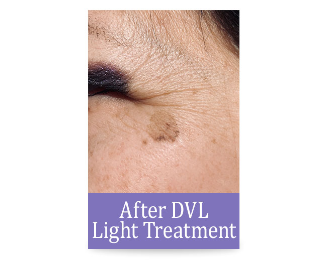 After DVL Light Treatment