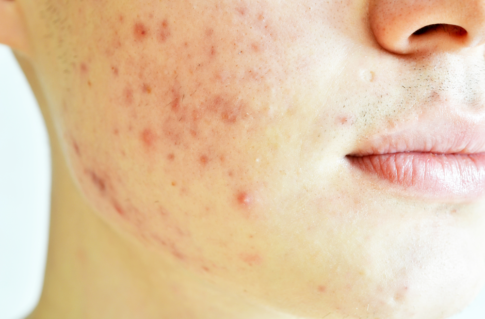 Adult-onset Acne