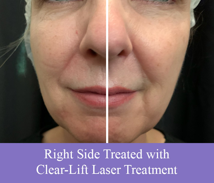 clear-lift-laser-treatment clear-lift-laser-treatment