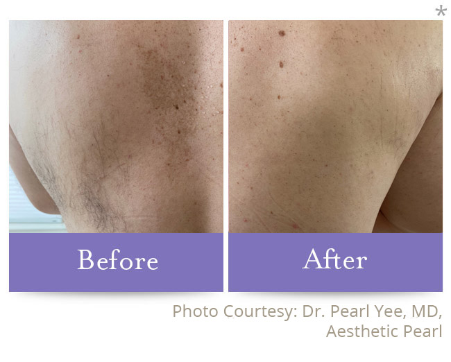 Before & After | Skin Remodeling San Anselmo | Facial Rejuvenation San
