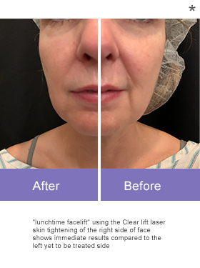 Before After Skin Remodeling San AnselmoRejuvenation San